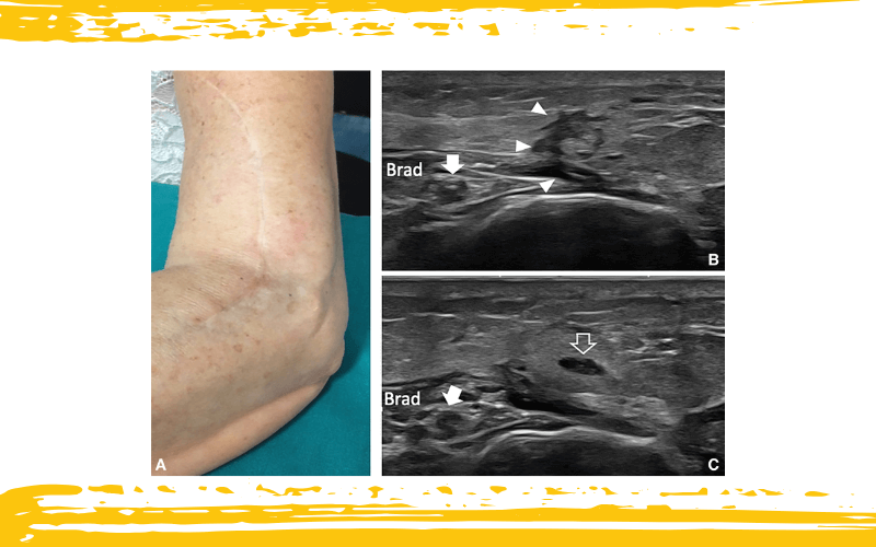 3. Nervio cutaneo posterior antebrazo tempo formacion ecografia.png